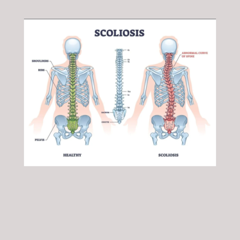 Scoliosis physiotherapy treatment Scoliosis physiotherapy treatment