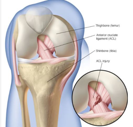 Anterior Cruciate Ligament Injury