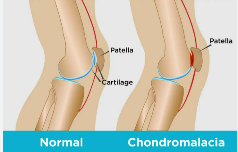 Screenshot 2026-07-26 100133 Chondromalacia Patella Physiotherapy Treatment