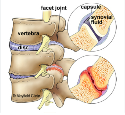 facet joint syndrome treatment facet joint syndrome treatment