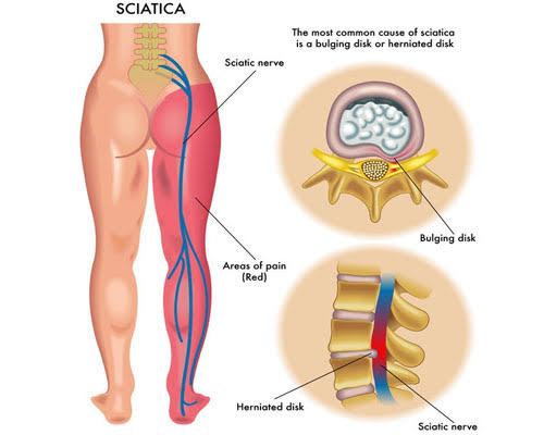 slip disc physiotherapy treatment