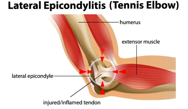 Tennis Elbow
