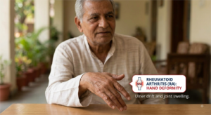 Rheumatoid Arthritis Physiotherapy Treatment In Gurgaon