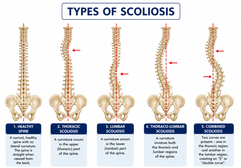 Scoliosis Physiotherapy Treatment In Gurgaon Spinal Stenosis Physiotherapy Treatment