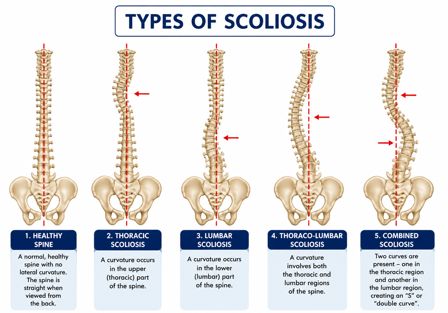 Scoliosis physiotherapy