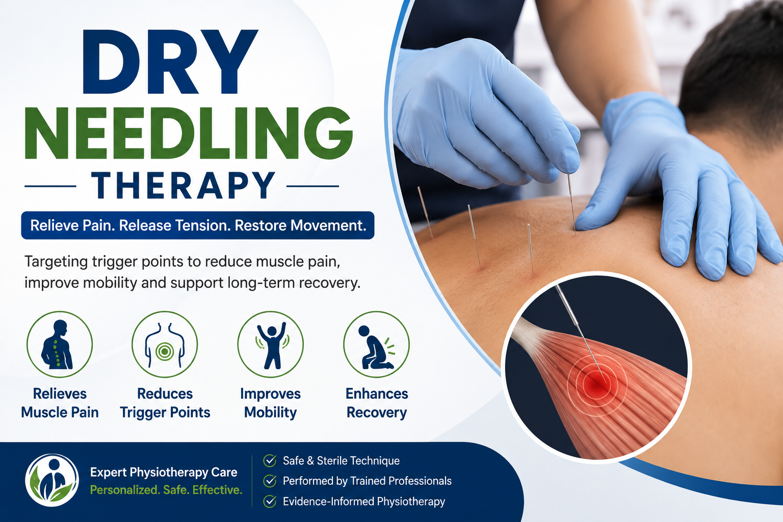 dry needling therapy