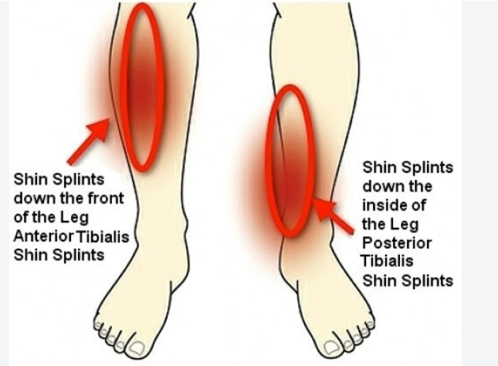 Shin Splints Physiotherapy Treatment